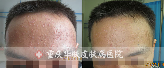 重庆西南医院如何护理皮肤病