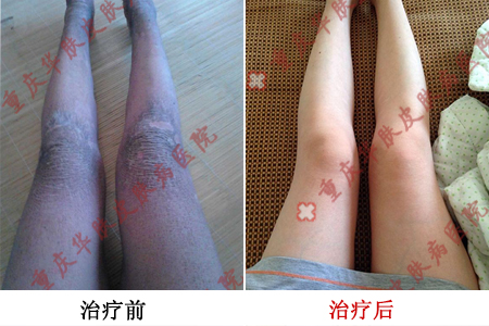 重庆皮肤病医院,重庆皮肤病医院哪家好_排名_怎么样_地址电话