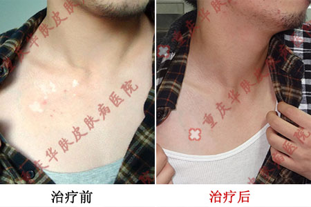 重庆皮肤病医院,重庆皮肤病医院哪家好_排名_怎么样_地址电话
