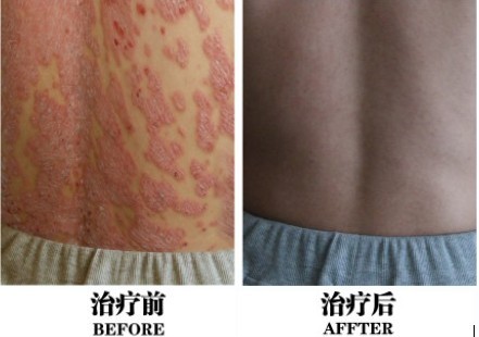 重庆人民医院治疗皮肤病出名专家