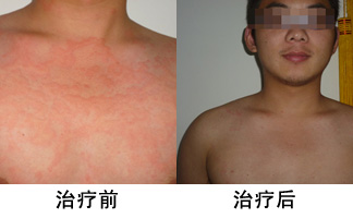 荨麻疹案例，荨麻疹病因，荨麻疹治疗方法_重庆荨麻疹医院