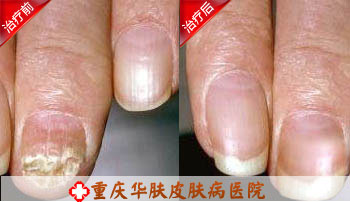 重庆西南医院治疗皮肤病效果怎样