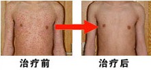 重庆鱼鳞病医院,治疗鱼鳞病最好的医院,重庆皮肤病医院_皮肤科_预约挂号