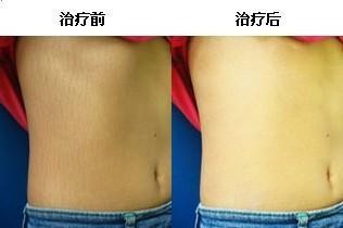 荨麻疹案例,荨麻疹病因,荨麻疹治疗方法_重庆荨麻疹医院