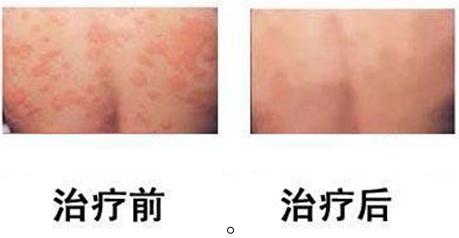 荨麻疹案例，荨麻疹病因，荨麻疹治疗方法_重庆荨麻疹医院