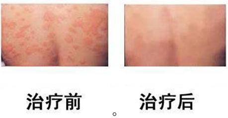 荨麻疹案例,荨麻疹病因,荨麻疹治疗方法_重庆荨麻疹医院
