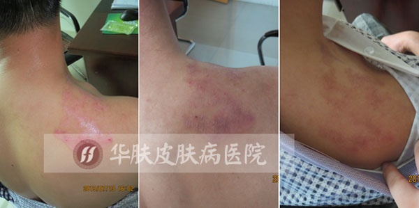 重庆西南医院治疗皮肤病费用
