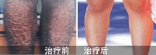 重庆皮肤病医院,重庆皮肤病医院哪家好_排名_怎么样_地址电话
