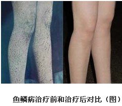 重庆鱼鳞病医院,治疗鱼鳞病最好的医院,重庆皮肤病医院_皮肤科_预约挂号