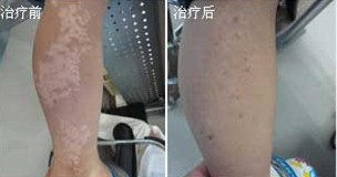 重庆皮肤病医院,重庆皮肤病医院哪家好_排名_怎么样_地址电话