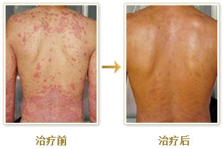 重庆皮肤病医院,重庆皮肤病医院哪家好_排名_怎么样_地址电话