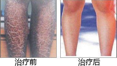 重庆皮肤病医院,重庆皮肤病医院哪家好_排名_怎么样_地址电话