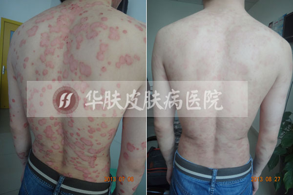 重庆西南医院治疗皮肤病案例